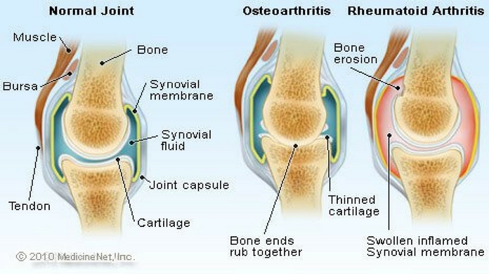 symptoms and treatment for arthritis