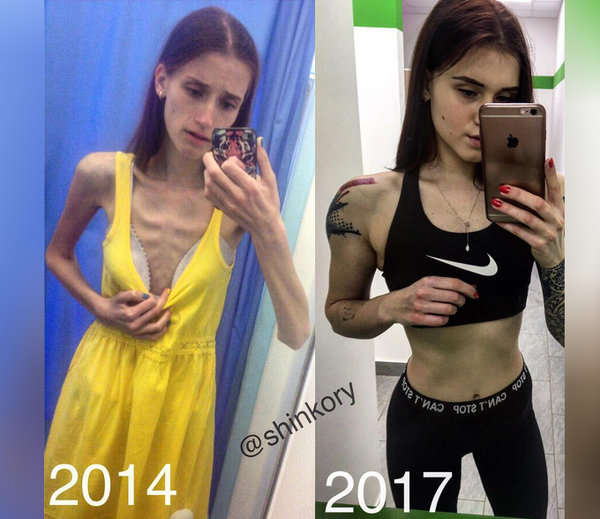 from anorexic to gym trainer