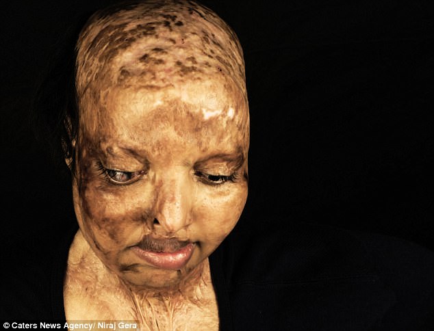 love story of acid attack victim pramodini
