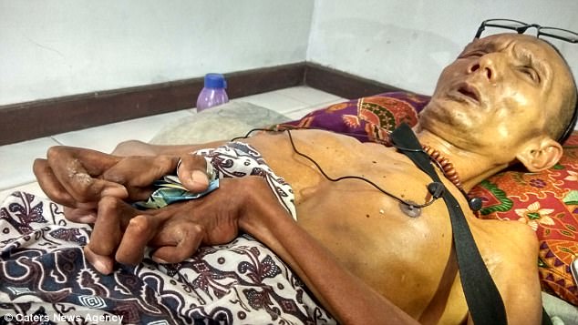 man left with limbs stiff as wood for two decades