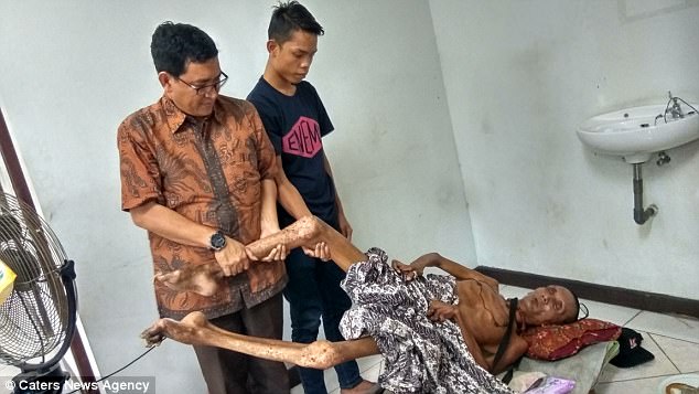 man left with limbs stiff as wood for two decades