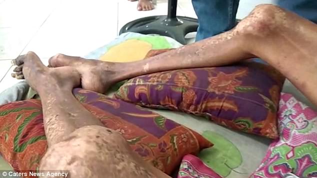 man left with limbs stiff as wood for two decades