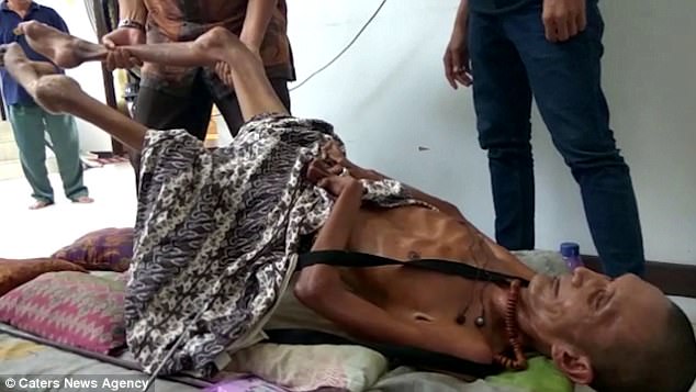 man left with limbs stiff as wood for two decades