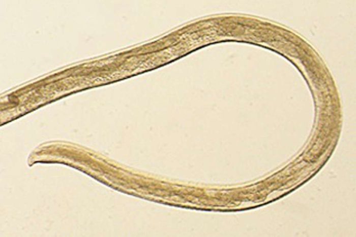  14 worms pulled from woman eye