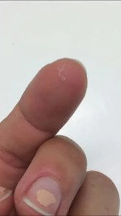  14 worms pulled from woman eye
