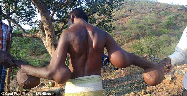 man lives with 18kg tumor