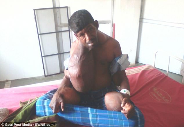 man lives with 18kg tumor