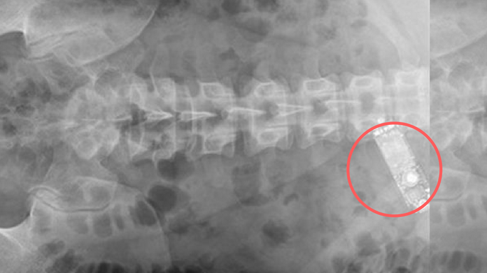 xray