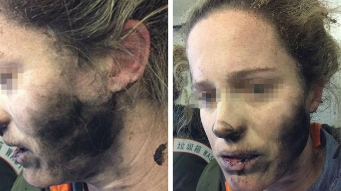 woman badly burned when her HEADPHONES exploded