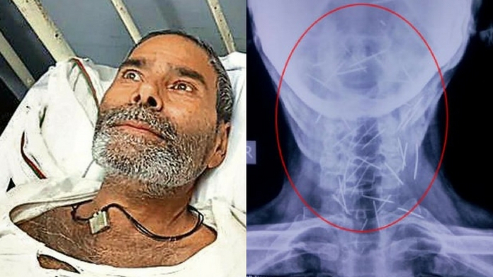 75 pins found from human body