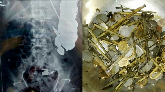 263 coins found from stomach