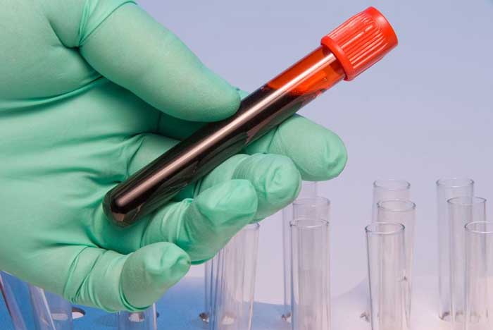 malayali nurse gets 5 year jail term for switching blood sample