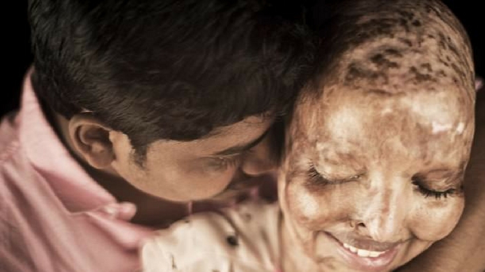 love story of acid attack victim pramodini