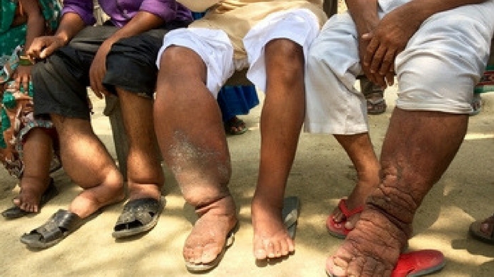 filariasis