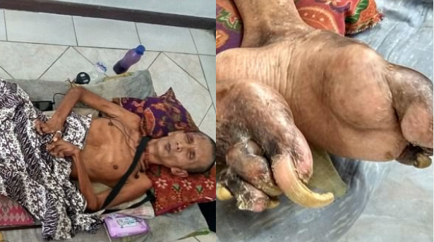 man left with limbs stiff as wood for two decades