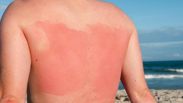 sunburn alert issued