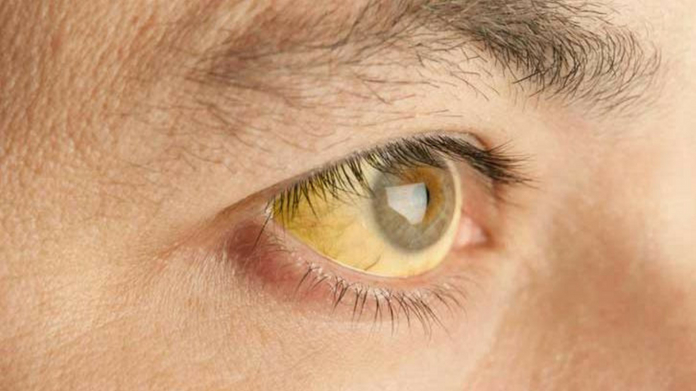 Jaundice