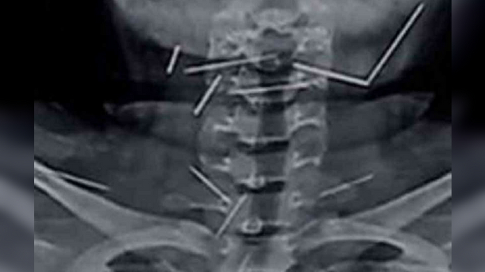 9 Needles Inserted Into Girl's Throat alleges blackmagic