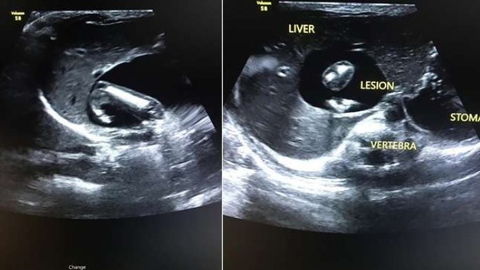 fetus operated from 45 year old boy