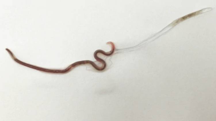 Japanese woman goes to doctor for sore throat find live worm