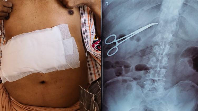 surgical instrument was forgotten in patients body