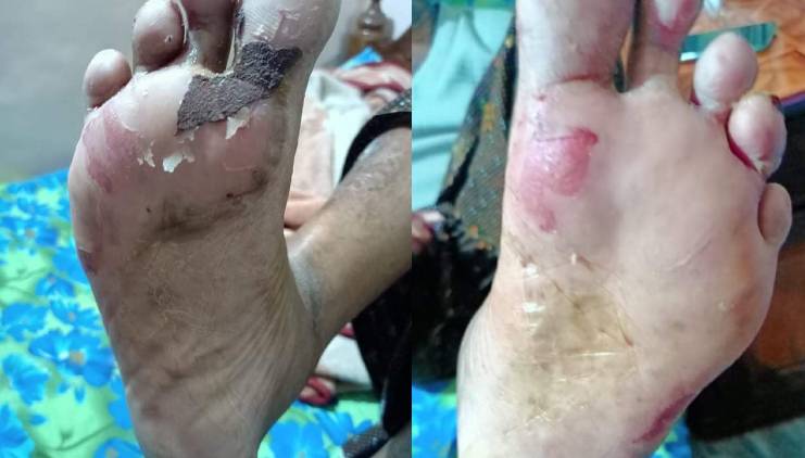 Pour the glue into the shoe; Leg injury