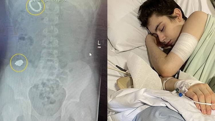 boy swallowed magnetic spheres