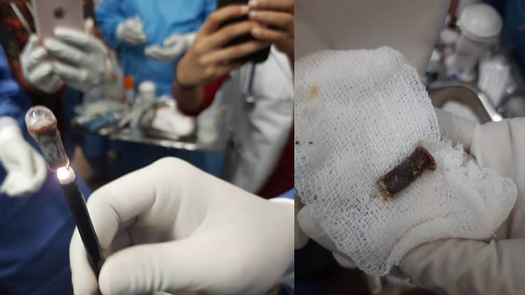 woman swallowed whistle lived with it for 25 years