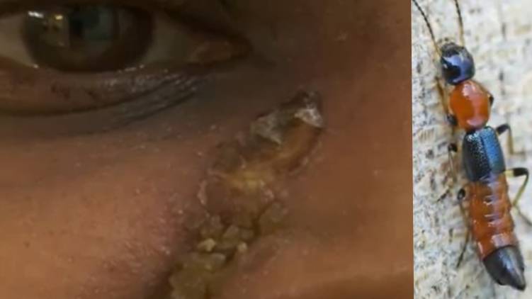 kakkanad blister beetle causes skin problem