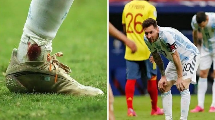 Messi Bleeding Ankle Colombia