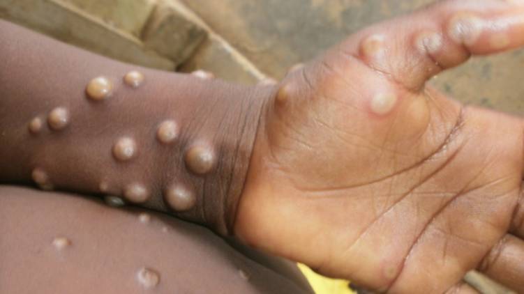 monkey pox symptoms treatment 24 explainer