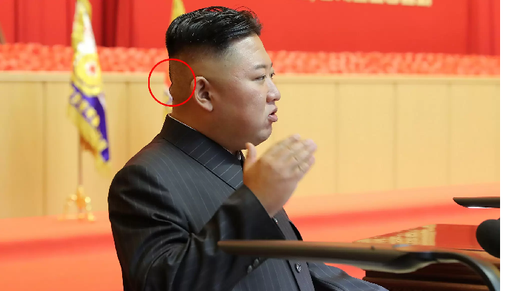Kim Jong Un’s head bandage