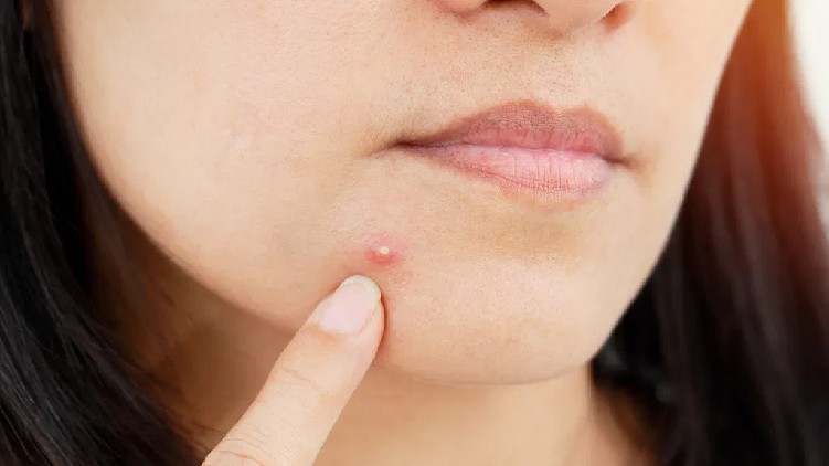 Five habits that cause acne