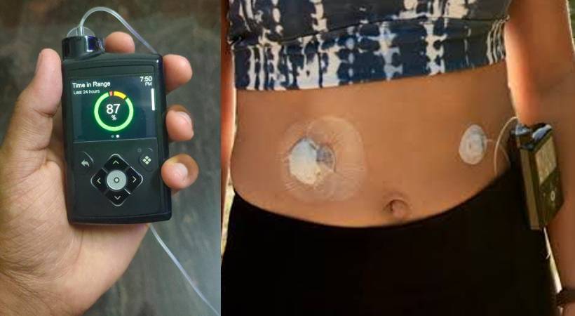 artificial pancreas in India