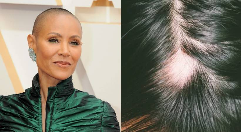 what is alopecia symptoms