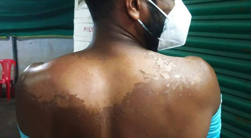 ernakulam youth sunburn