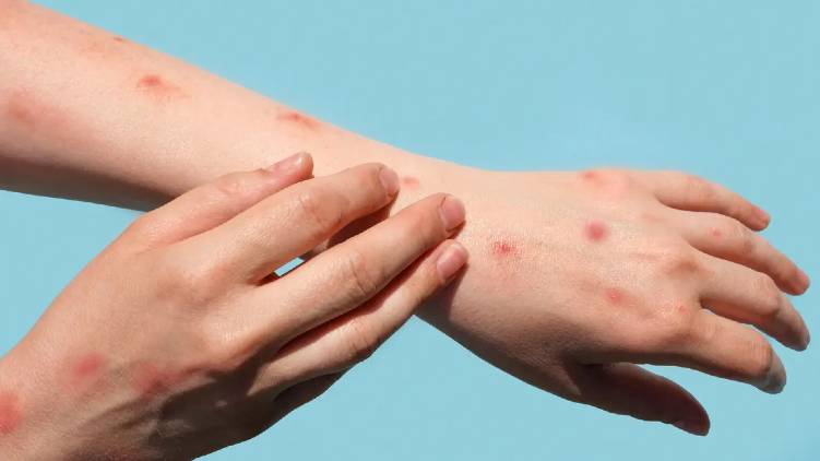 Saudi Arabia reports first case of Monkeypox