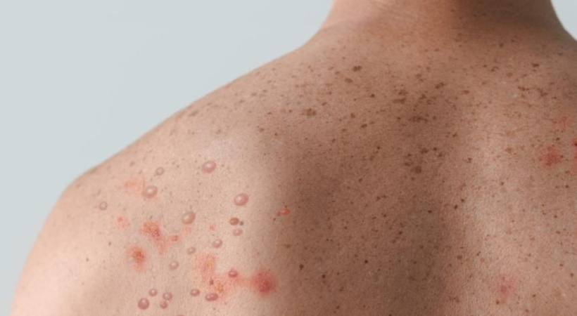 health secretary give alert on monkeypox