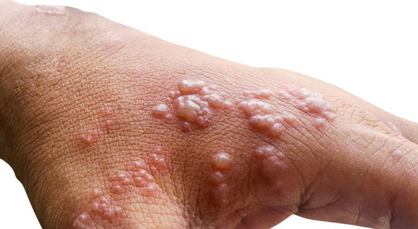 monkeypox central team to hold discussions with kerala health minister