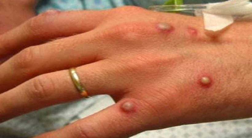 thrissur monkey pox suspected death test report today