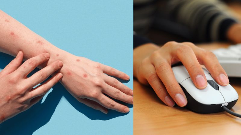 monkeypox virus can stay on computer mouse and other device for days