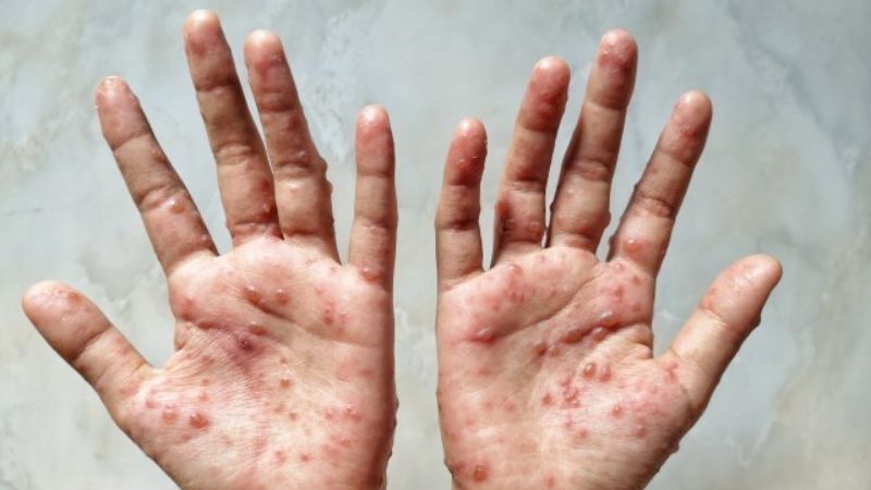 another monkey pox case reported in delhi