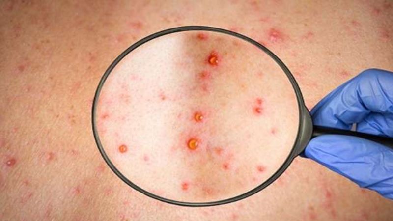 First monkeypox case confirmed in Bahrain