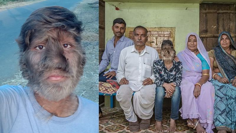 7 year old have rare disease called werewolf Syndrome