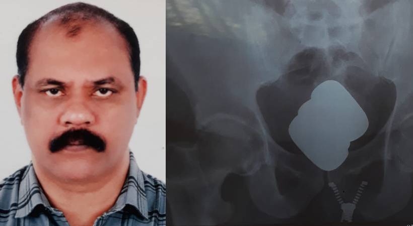 man hid gold in abdomen