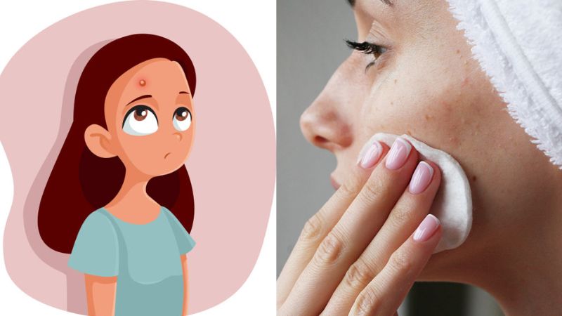4 ways to prevent adult acne