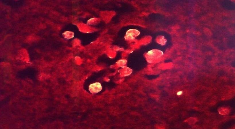 brain eating amoeba death south korea