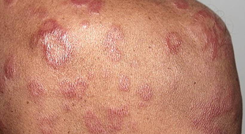 leprosy symptoms