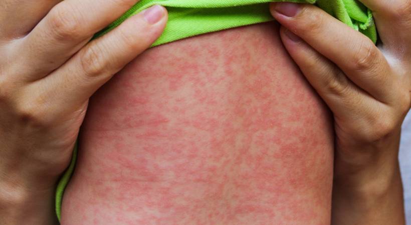 measles grips nadapuram