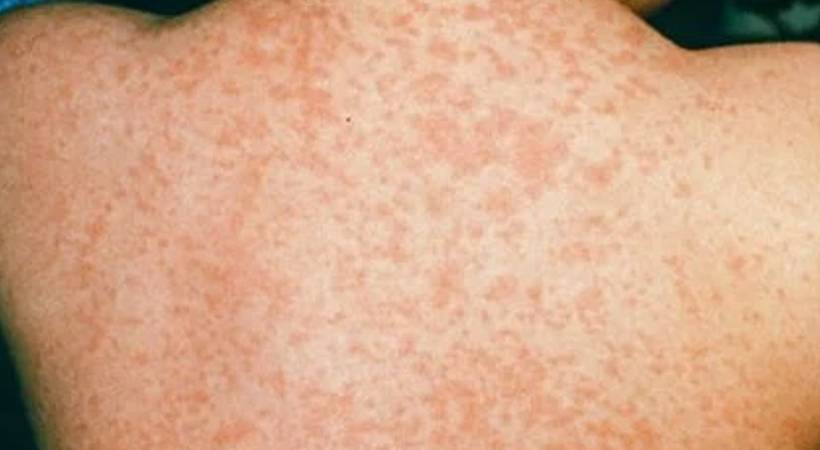 measles spread in nadapuram
